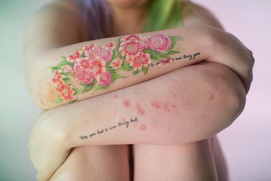 Kvinne med påmalt blomstermotiv på den ene armen og utslett i samme farge på den andre.