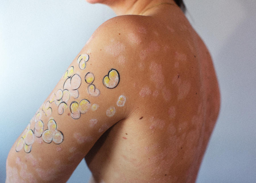 Kvinne med påmalte blomster på den ene armen og liknende hudutslett på ryggen.